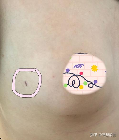 乳腺结节微创手术视频,技术革新与康复之路